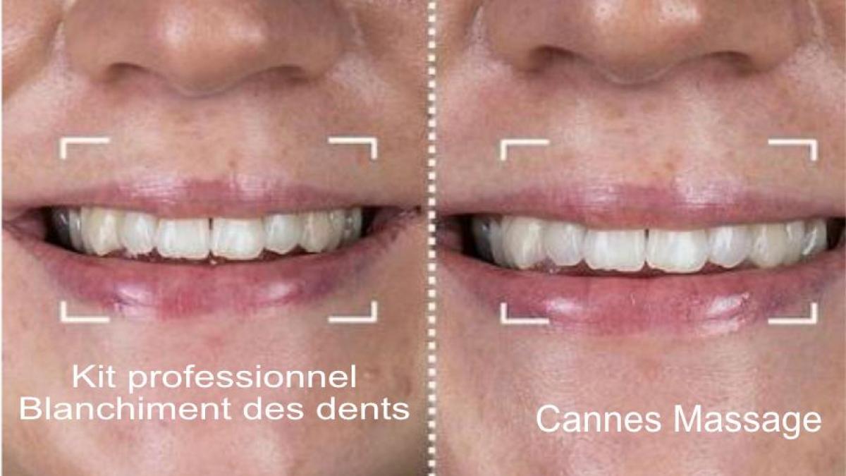 Kit professionnel blanchiment des dents